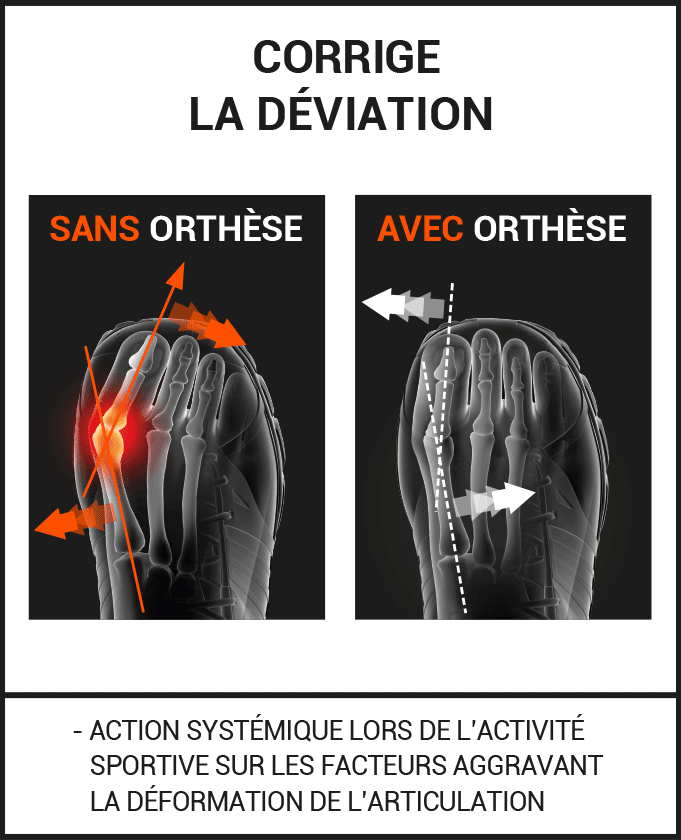 Epitact - Hallux Valgus - Le coureur nordique